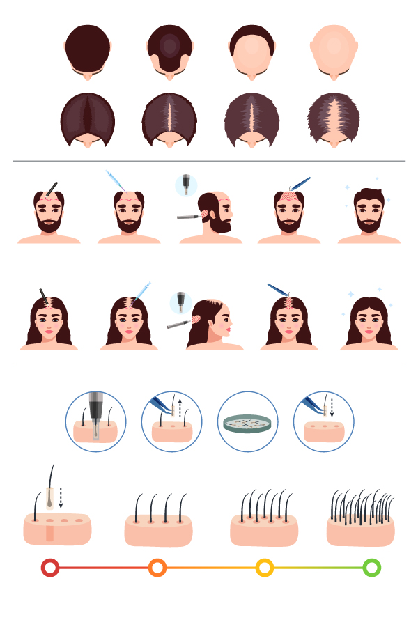 Tratamiento FUE (Follicular Unit Extraction)